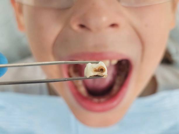 Best Knocked-Out Tooth (Avulsed Tooth) Treatment in Briarcliff, TX